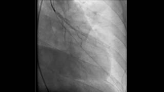 Asvide: Coronary angiogram showing occluded proximal left anterior descending artery from SCAD