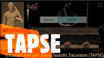 Measure TAPSE or TAM. Perioperative & Critical Care ECHO / POCUS
