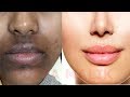 How To Remove Dark Black patches, Dark Spots,Hyper pigmentation, Around Your Mouth  PRIYA MALIK