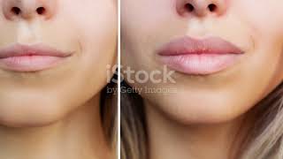 Lip Augmentation: Fillers, Collagen & More
