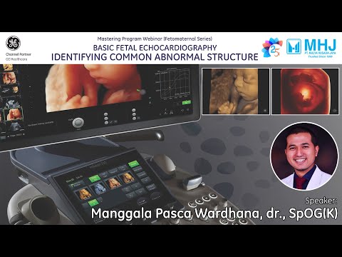 Video: Mucopolysaccharidosis Tipe VI: Laporan Kasus Dengan Presentasi Neonatal Pertama Dengan Ascites Fetalis Dan Manifestasi Jantung Progresif Cepat