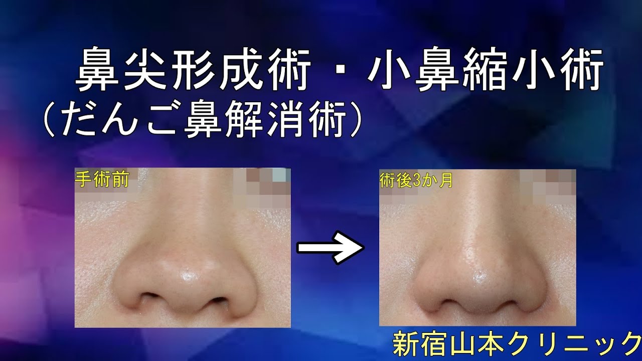 小鼻縮小 鼻の膨らみを小さくする 山本クリニック Youtube