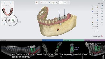 3Shape Implant Studio - Planejamento de implante