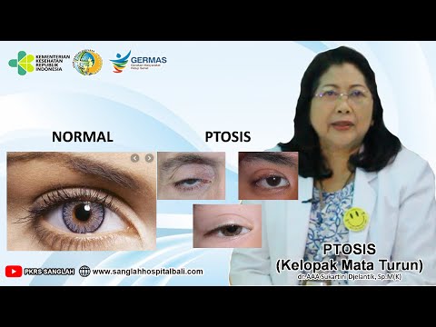 Jangan Meremehkan Kelopak Mata Turun (PTOSIS)!