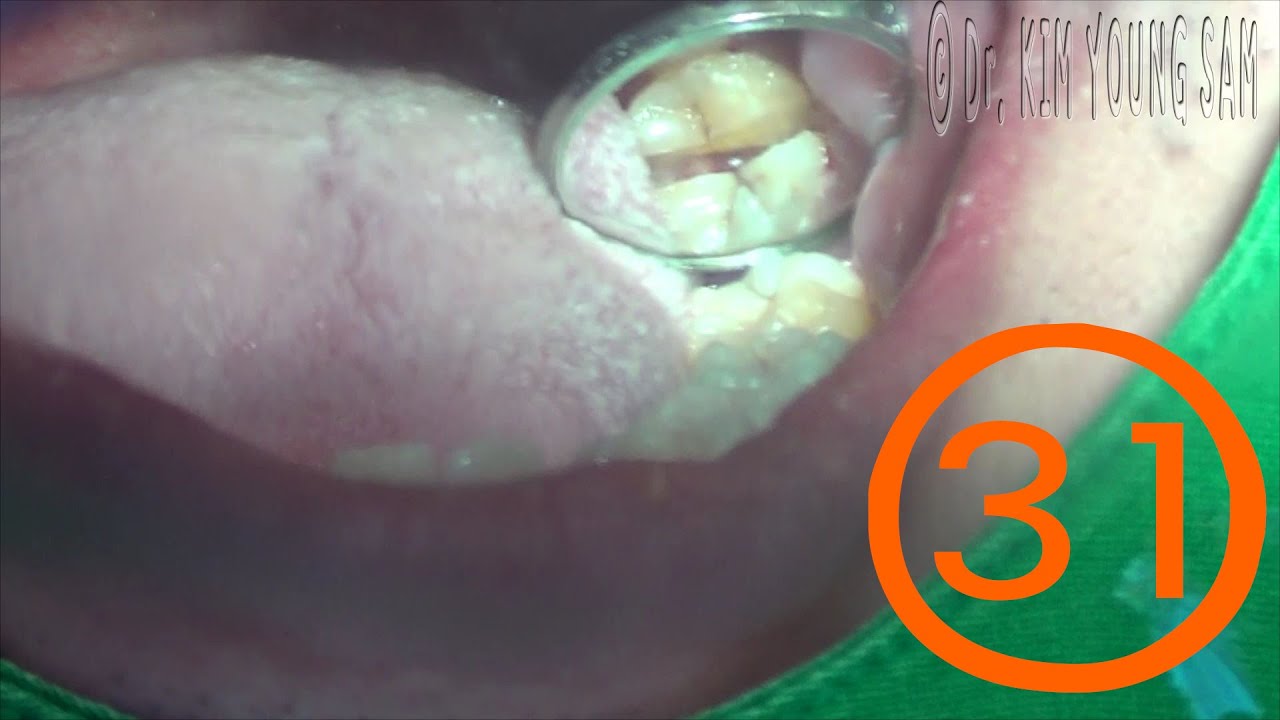 Removal of vertical impacted wisdom tooth(#38) with forcep - 하악수직매복사랑니
