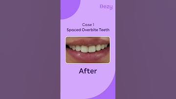 Clear Aligners Before and After Treatment Results | Transform Your Smile at Dezy