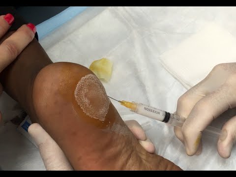 Heel spur steroid injection