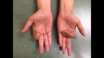 Osteotomy Finger CPT code - simplify medical coding