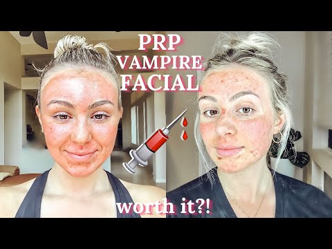 $1,000 Vampire Facial Experience (PRP with Microneedling)