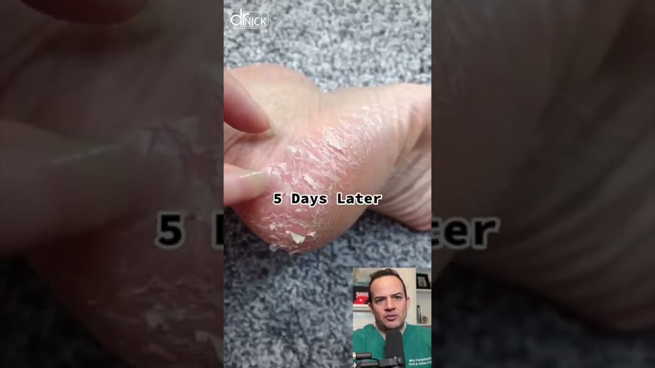 DOCTOR REACTS TO CHEMICAL FOOT PEEL Shorts Reaction