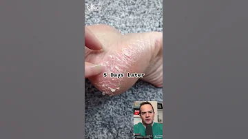 DOCTOR REACTS TO CHEMICAL FOOT PEEL Shorts Reaction 