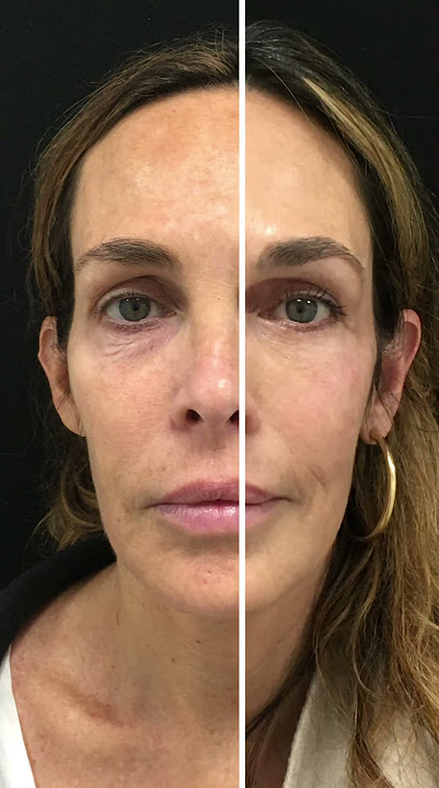 Before and After: Lower Blepharoplasty, Upper Blepharoplasty and Facial Fat Transfer