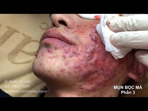 Video Nặn mụn nhọt bọc siêu to siêu nhiều xem rất kích... - youtube