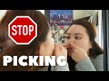 How to STOP PICKING your face acne | Simple yet effective tips on how to stop picking skin