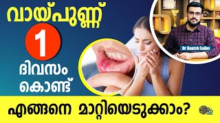 1294: വായ്പുണ്ണ് ഒറ്റ ദിവസം കൊണ്ട് മാറാനുള്ള മാർഗ്ഗങ്ങൾ | Cure Aphthous Ulcer in one day