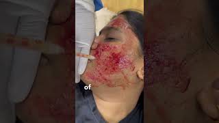 Vampire face lift #How to get rid of acne scars🤔here is the solution 😀 #celebritysurgeon