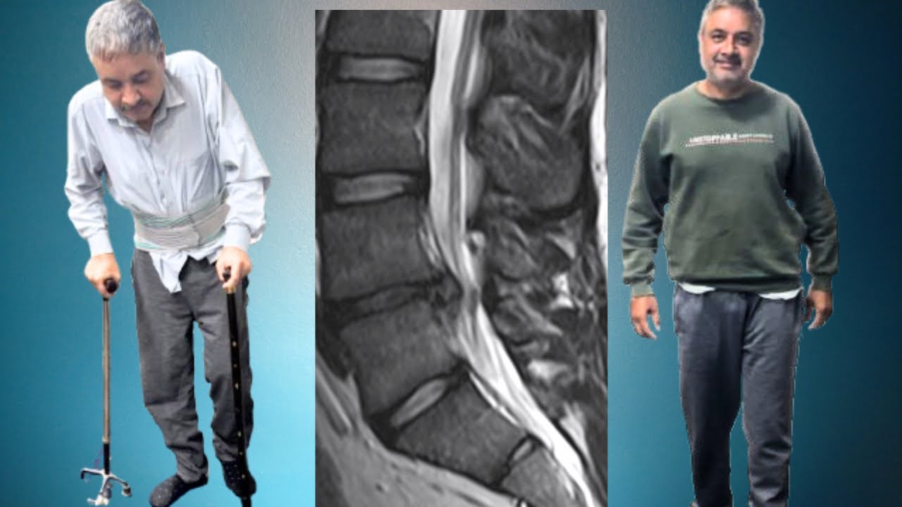 Severe L5–S1 PIVD | Patient Unable to Walk for 2 Months | Pain Relief After Treatment