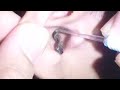 Top 3 Favorite Earwax Removal in Men