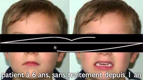 Béance sur un enfant de 5 ans - correction avec 6mois d