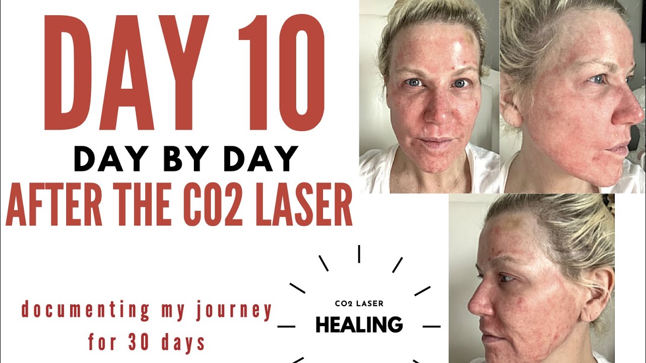 C02 LASER healing DAY 10 the reality!!!!!!! WARNING this has been