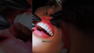 Discover No-Prep Veneers