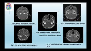 Arti Gosavi | HIDDEN DEFECTS: EXPLORING INNER EAR MALFORMATION.