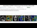 Building a ConvNet for Knee injury classification from MRI exams and interpret its predictions