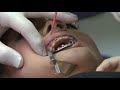 How to Save on Dental Braces