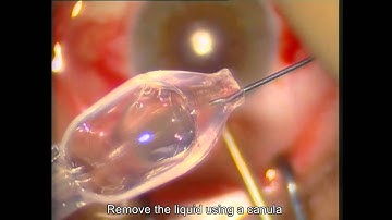 PRE-LOADED LENTICULE USAGE FOR (UT)DSAEK