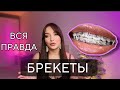 БРЕКЕТЫ — МОЯ ИСТОРИЯ: СТОИМОСТЬ, ПОДВОДНЫЕ КАМНИ, ГИГИЕНА, ОБЕЩАНИЯ, РЕЗУЛЬТАТЫ НА СЕГОДНЯ. Часть 1
