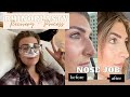 I GOT A NOSE JOB |  My Recovery Process VLOG in Dallas