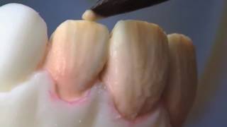 Matrix Mamelons HeraCeram ceramics