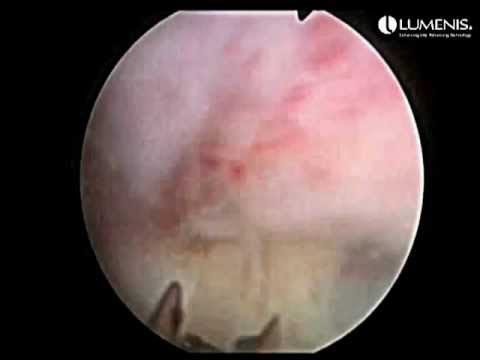 Prostate Surgical Procedure Holep