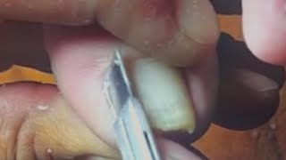 Thumb nail trimming, toenail clean and round 【FanYi】