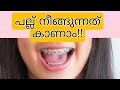 പല്ലുകൾ നീങ്ങുന്നത് / pallil kambi idunnath/pallil kambi/braces/pallil kambi idunnath malayalam