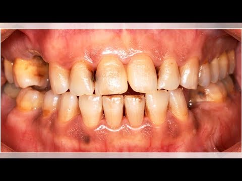 Can Dip Cause Bleeding Gums? | Tita TV