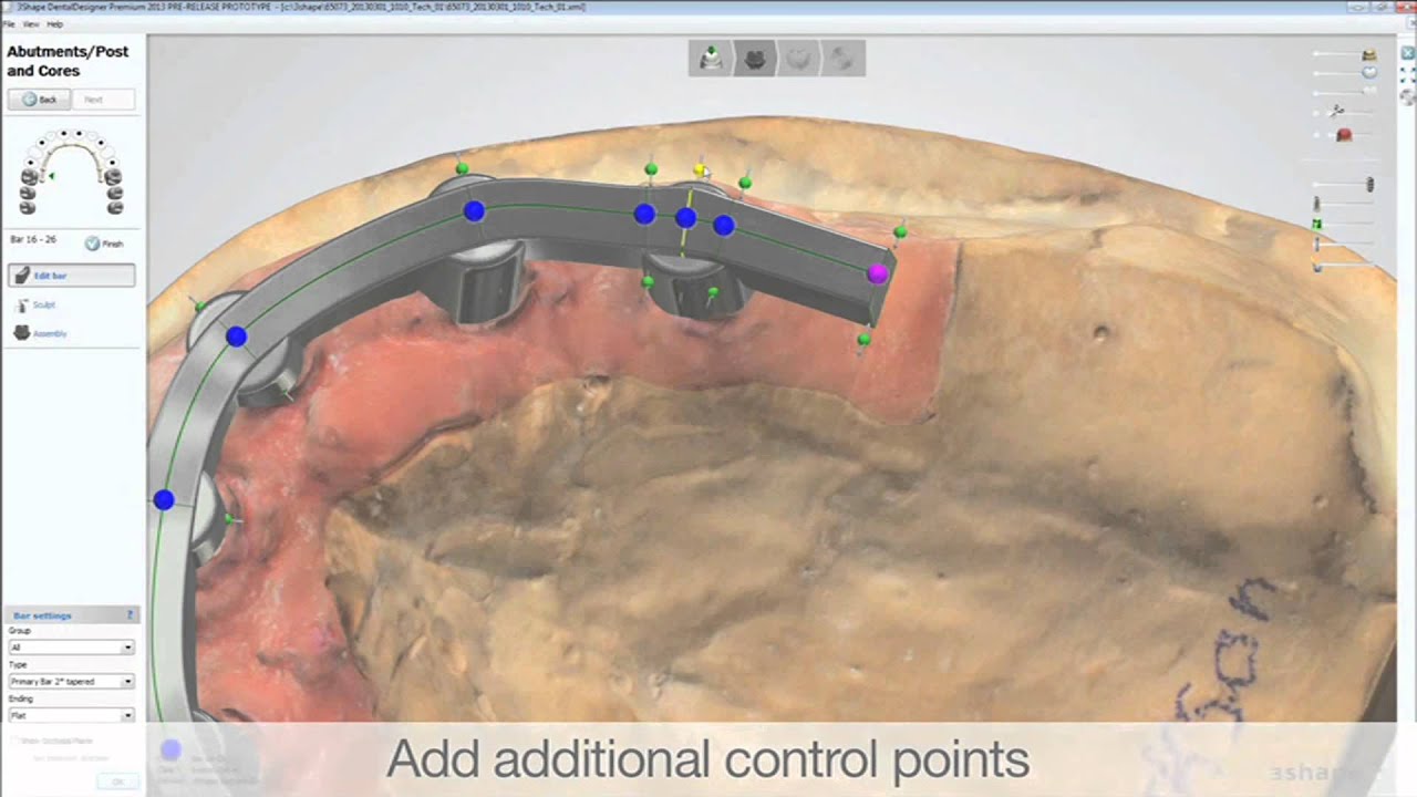 Dental System - Barres Implantaires par 3 shape / Dental System ...