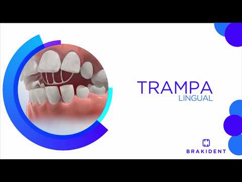 Trampa Lingual