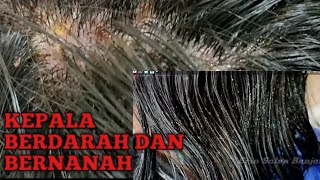 DETIK-DETIK KEPALA MENGELUARKAN DARAH DAN NANAH || KARENA KETOMBE DAN KUTU RAMBUT