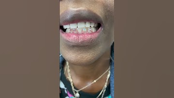 Sparkle and shine with our Tooth Gem 💎