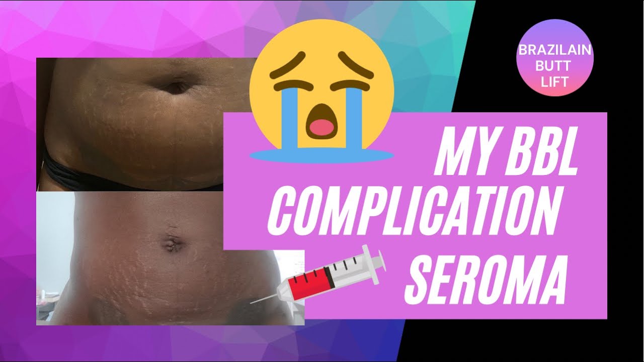 My BBL Complication Part 1 SEROMA YouTube my-bbl-complication-part-1-seroma-youtube