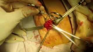 Plastia Umbilical Plastia Umbilical