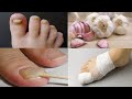 Do you suffer from nail fungus? This is an effective treatment from the first use