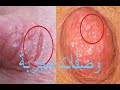 وصفة لتشققات حلمة الثدى وألم الرضاعة مجربة وفعالة 