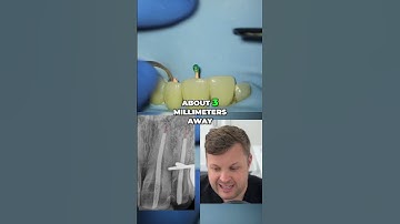 Can an Open Apex Affect Apex Locator Readings  📏🦷