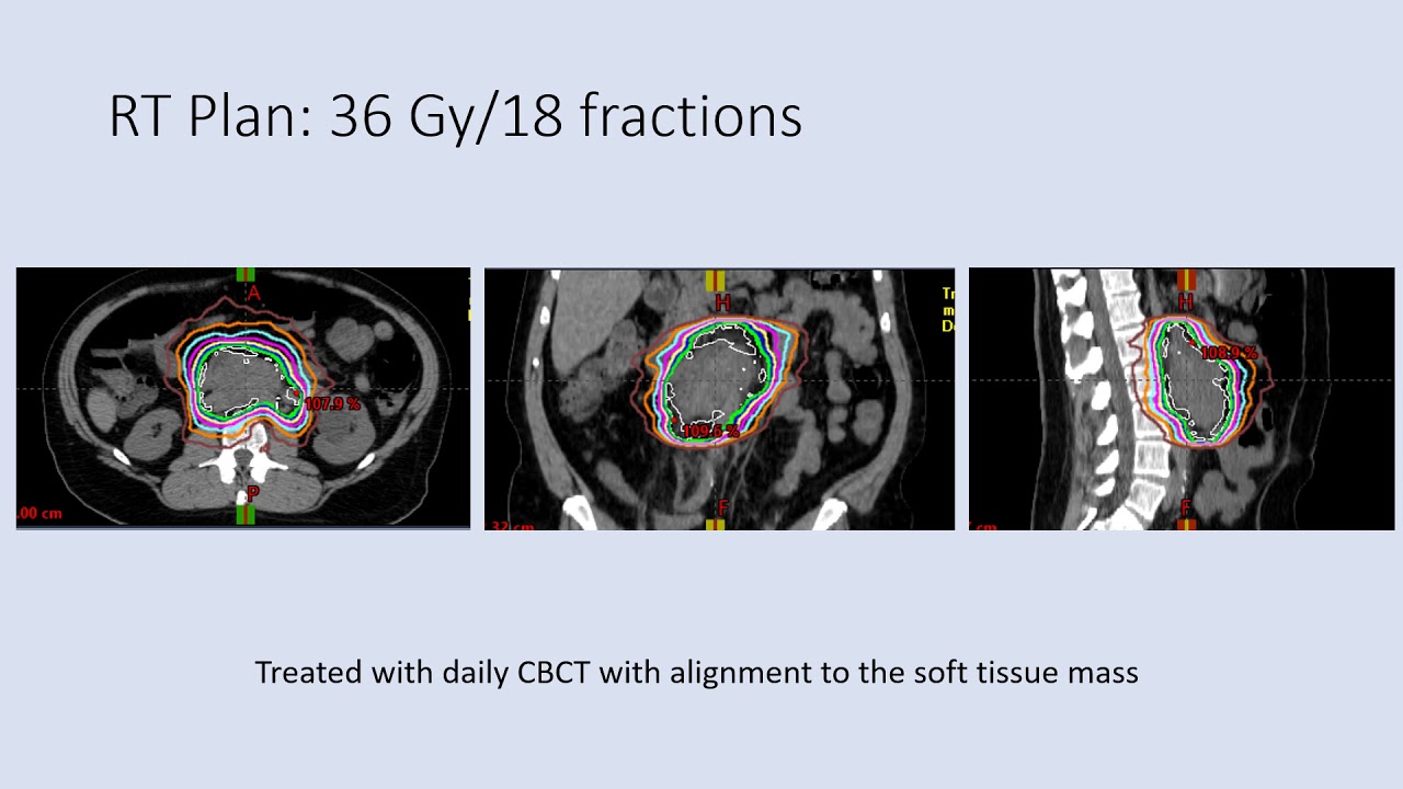 Dr. Sarah Milgrom: Radiation Therapy in the Management of Relapsed/Refractory Lymphoma