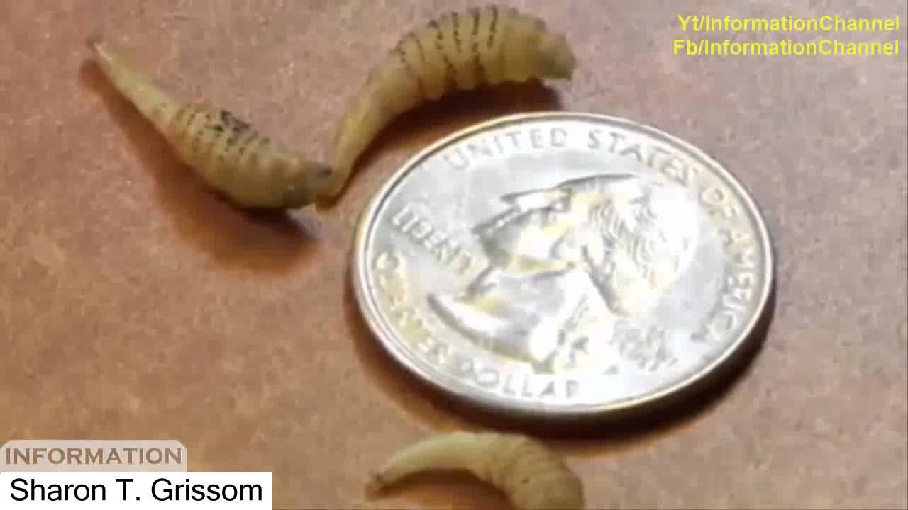 Treatment video 2016 Monster botfly and mangoworms in human treatment