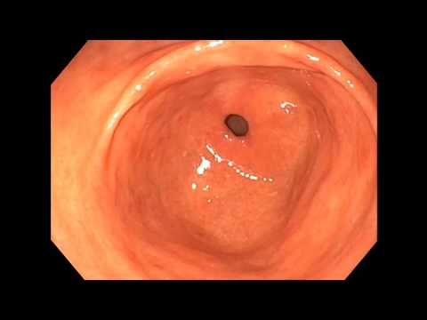 Video: Apa Itu Mucosa Erythematous? Antrum, Perut, Kolon, Dan Banyak Lagi