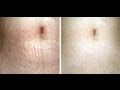 How To Get Rid Of Stretch Marks