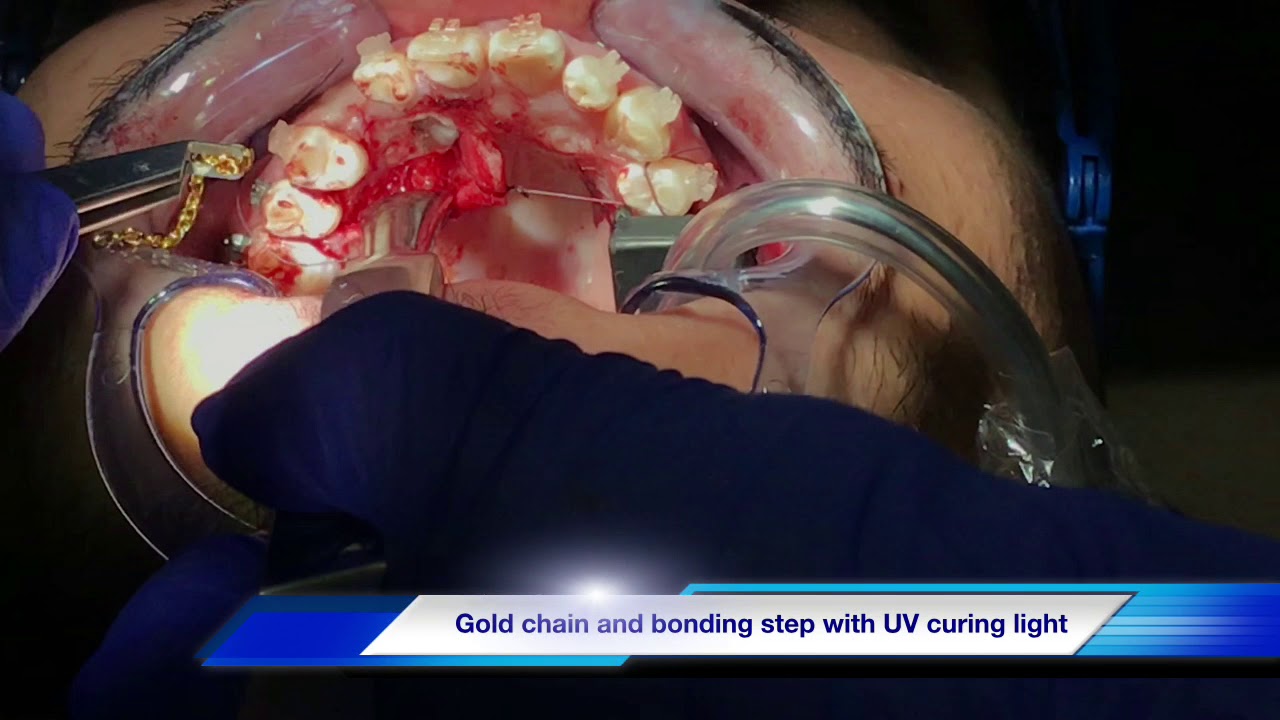 How to do surgical exposure of impacted upper right canine on a 22